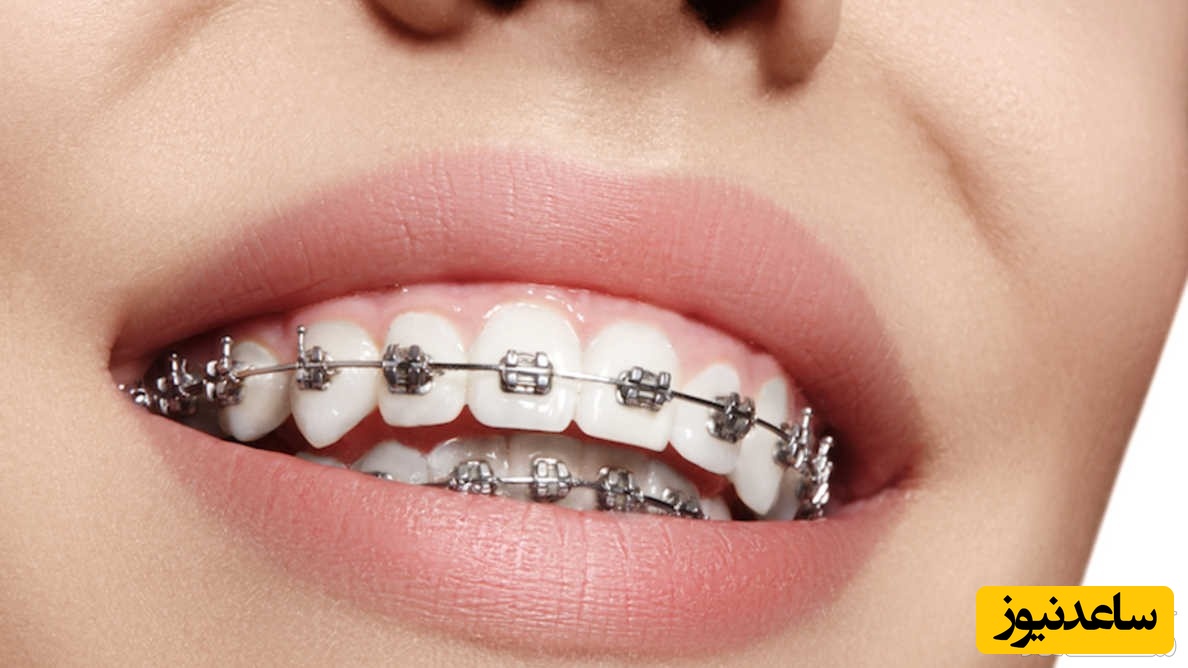 آشنایی با نحوه ی گرفتن موم بایت ارتودنسی و تریم کست پایین