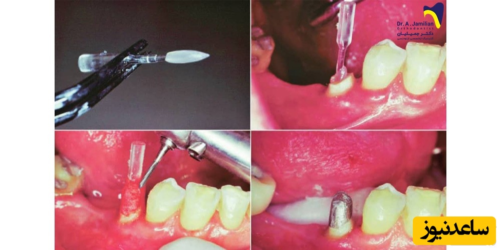 آشنایی با پست و کور دندان