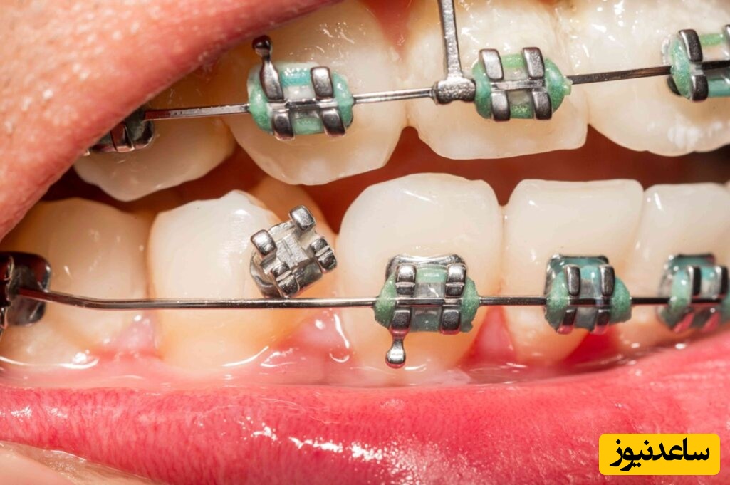 انواع مال اکلوژن چیست؟