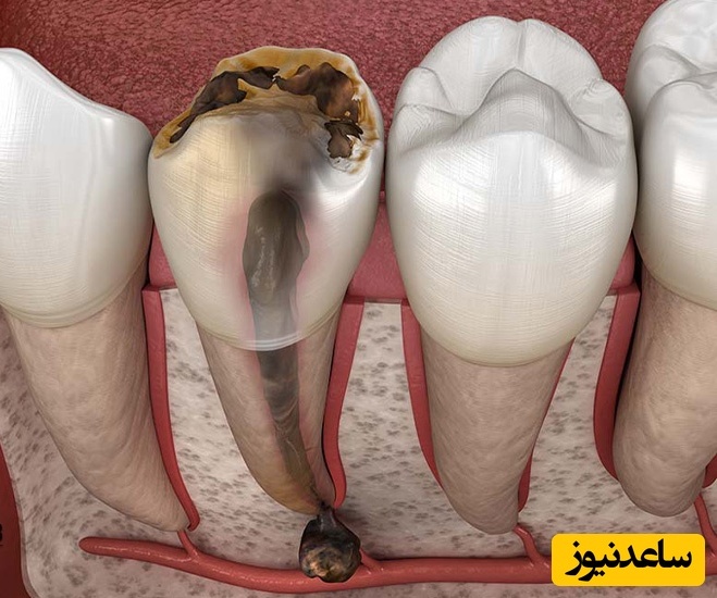 چه چیزی باعث سیاه شدن دندان ها می شود؟