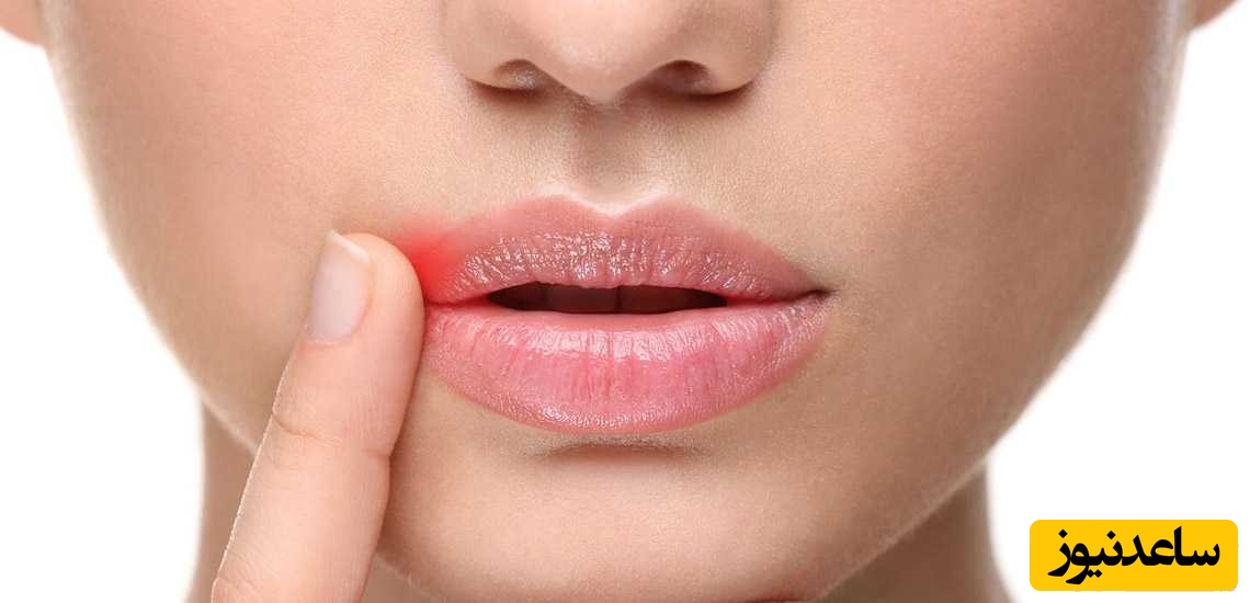 اگر دچار آفت دهان شده اید بخوانید!