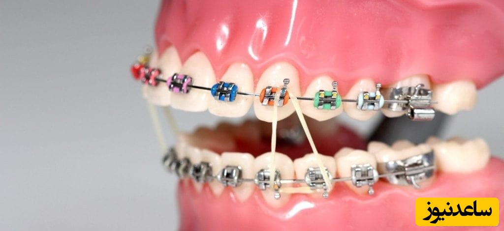 سفید کردن دندان ارتودنسی شده