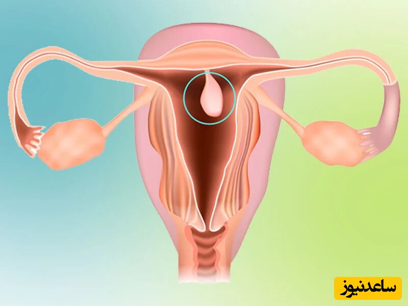 قطع نشدن خونریزی و طولانی شدن پریود چه دلایلی دارد؟