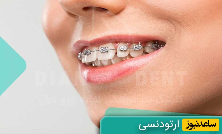 توصیه‌های مفید برای رفع بوی بد دهان در دوران ارتودنسی