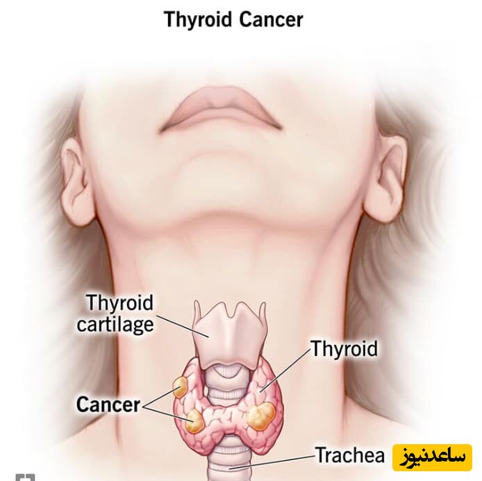 آیا سرطان تیروئید کشنده است؟ + درمان آن