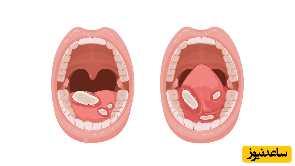 روش های درمان موکوزیت چیست؟