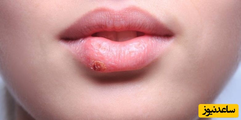 تبخال ؛ علائم، روشهای پیشگیری، درمانهای دارویی و خانگی