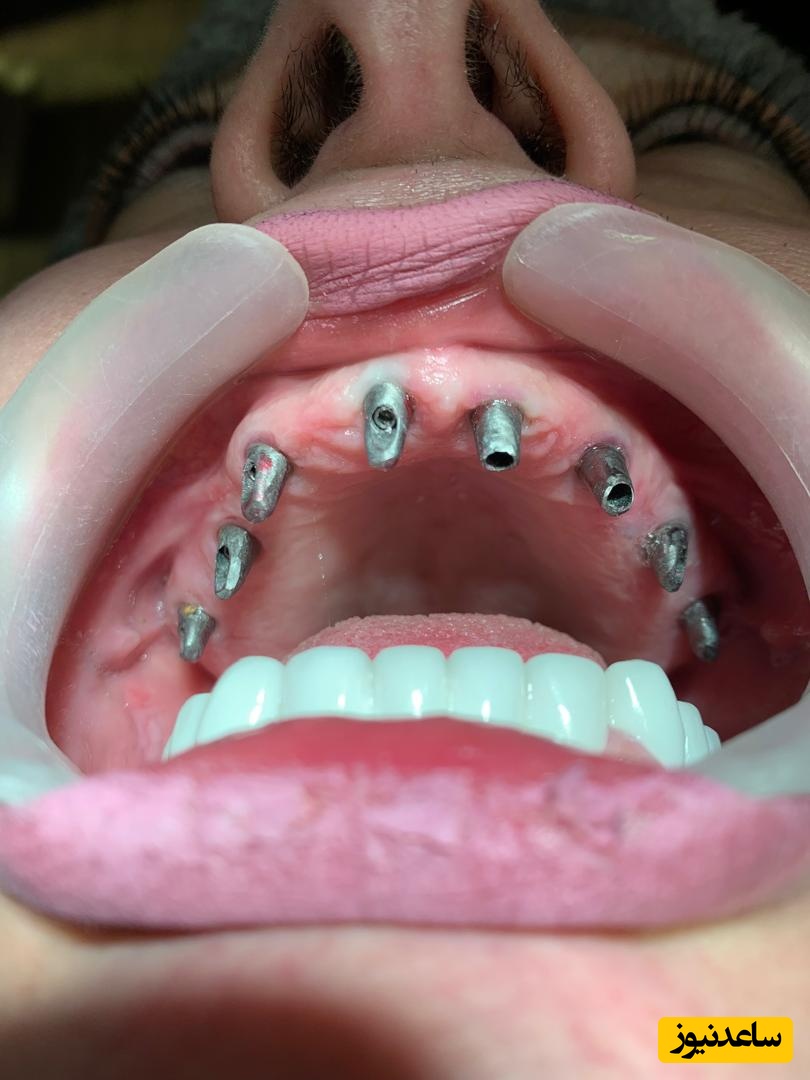 نحوه ی انتخاب بهترین برند ایمپلنت دندان