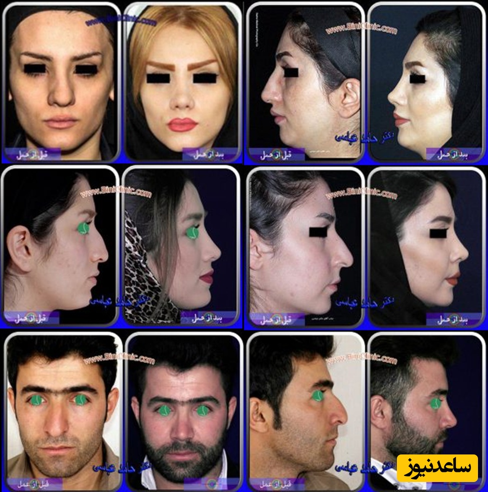 بررسی نمونه کارهای جراحی بینی دکتر عباسی