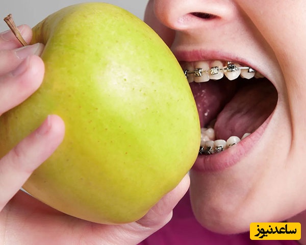 غذاهایی که نباید در دوران ارتودنسی مصرف کنید!