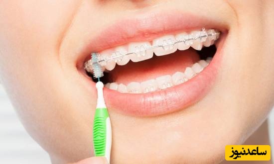 سوالات متداول در مورد مسواک زدن حین ارتودنسی