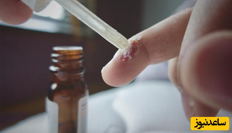 درمان HPV با اسید سالیسیلیک