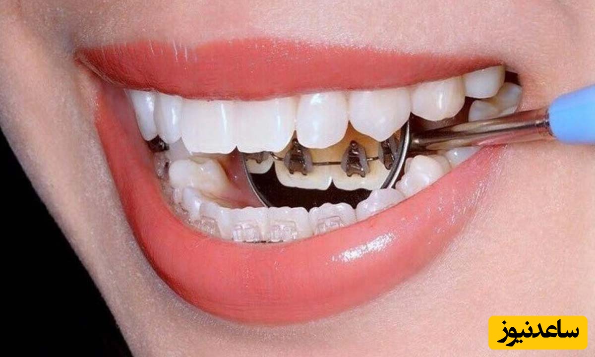 مهم‌ترین مزایا و معایب ارتودنسی لینگوال چیست؟