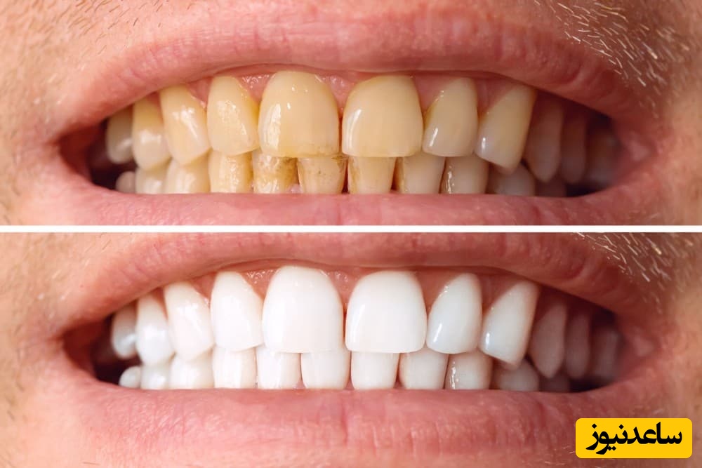 روش ها خانگی خاص برای سفید کردن دندان ارتودنسی شده