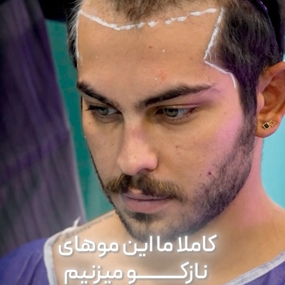ببینید| تغییر چهره به دستور همسر؟ ویدیوی پربازدید از عمل زیبایی ناگهانی ارسلان قاسمی پس از ازدواج با لیدا اولیائی