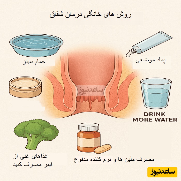 شقاق مقعد و موثرترین روش های درمان خانگی (تایید شده پزشکان در سال 2025)