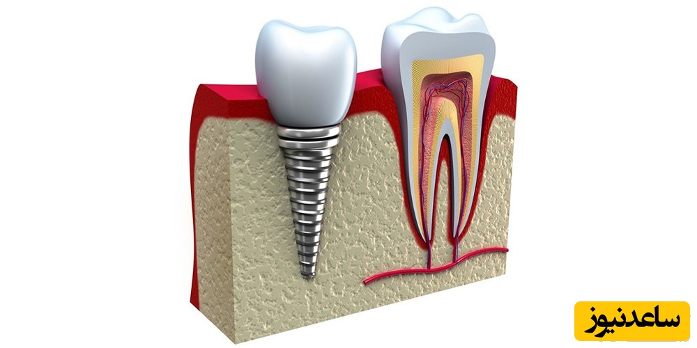 کی از ایمپلنت فوری استفاده کنیم؟
