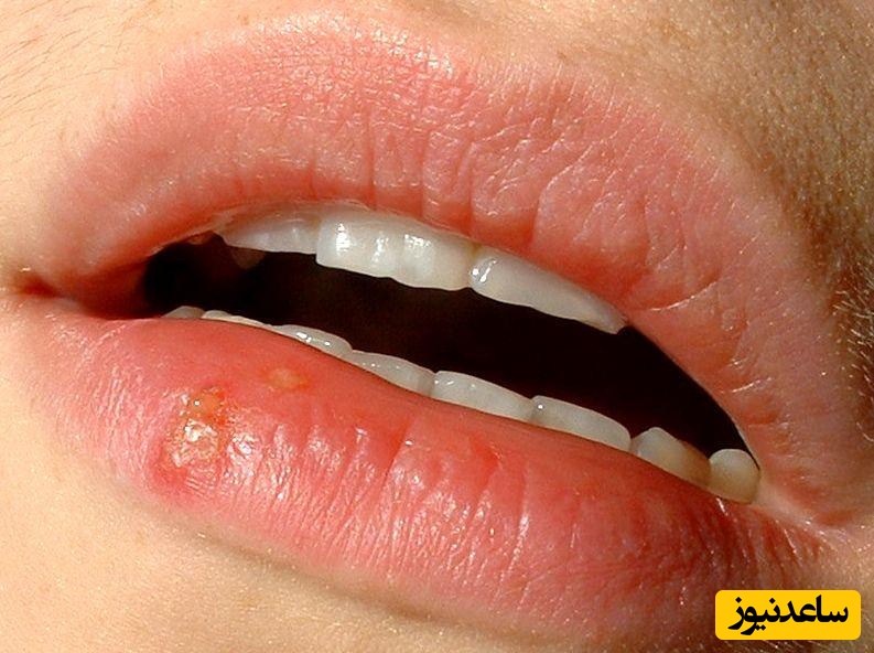فامسیکلوویر برای چه افرادی مناسب نیست؟ هشدارهای مهم قبل از مصرف
