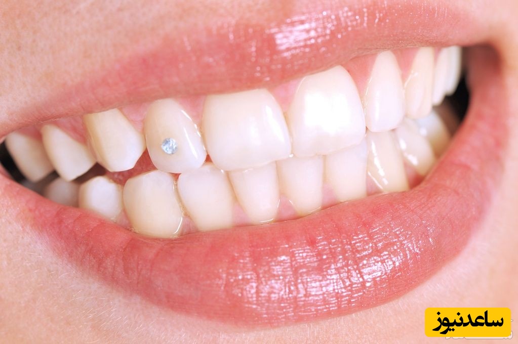 علائم و پیشگیری از فرسایش مینای دندان