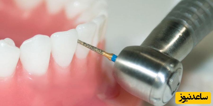  آیا تراشیدن دندان کار درستی است؟