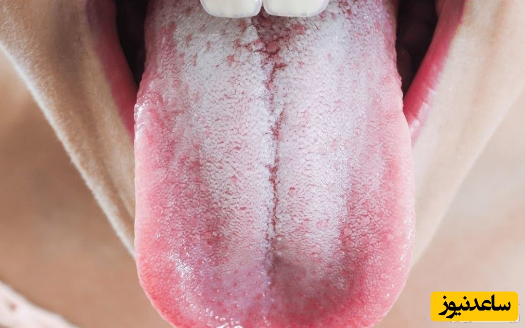 چه کسانی به برفک دهان مبتلا می‌شوند و علت آن چیست؟