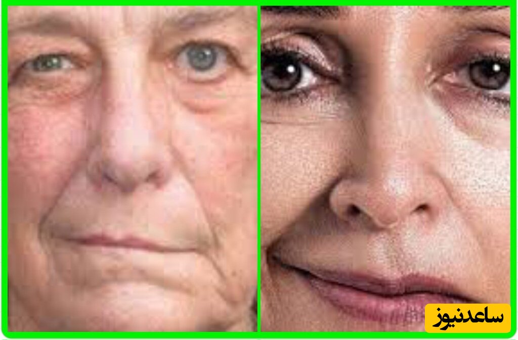 هشدار جدی؛ خطرفلج شدن صورت در کمین عاشقان