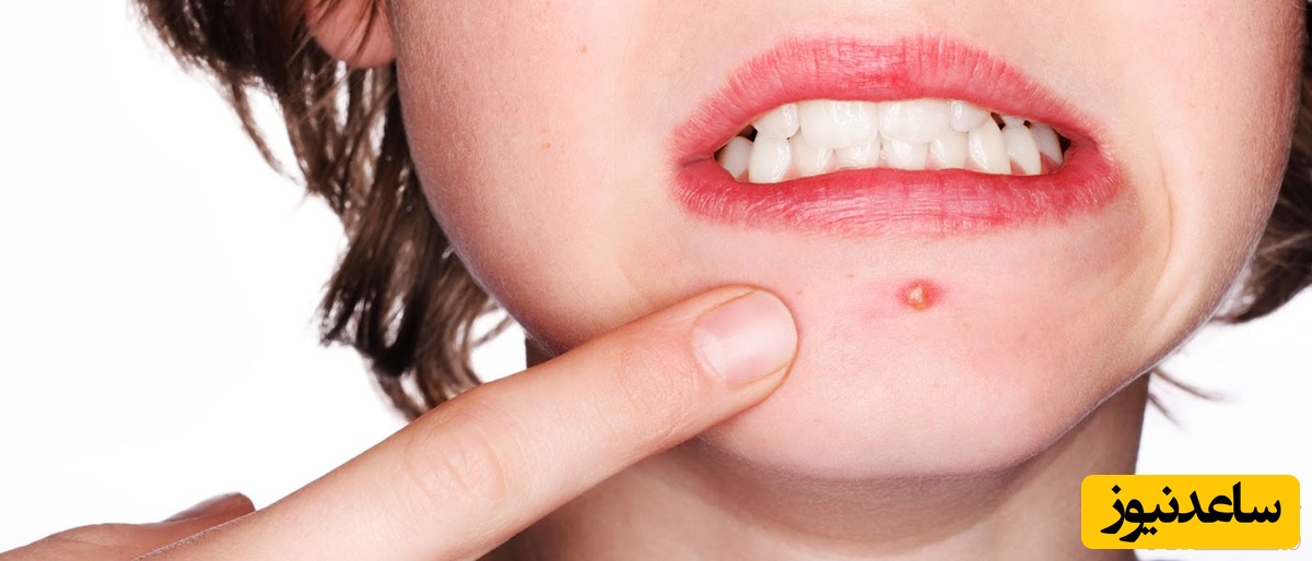 دیدن جوش در خواب چه تعبیری دارد؟ / تعبیر خواب جوش