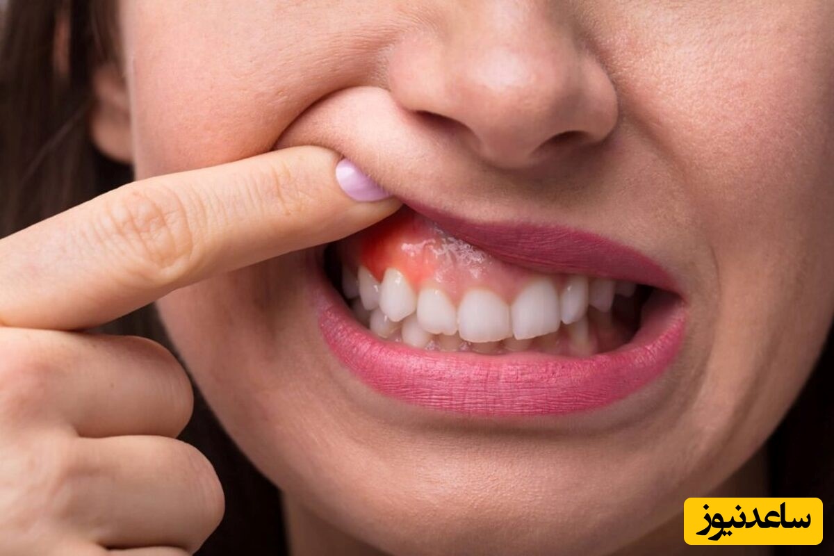 استفاده از دارو‌های خانگی برای درمان جوش لثه