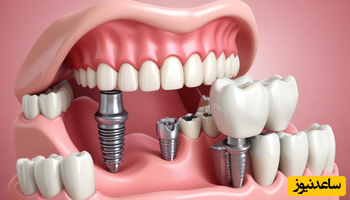 تکنیک‌های استفاده از انواع ایمپلنت چیست؟