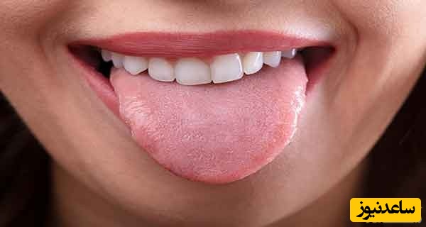 علل و درمان خشکی دهان