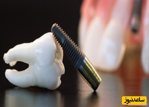 مواد تشکیل دهنده ایمپلنت