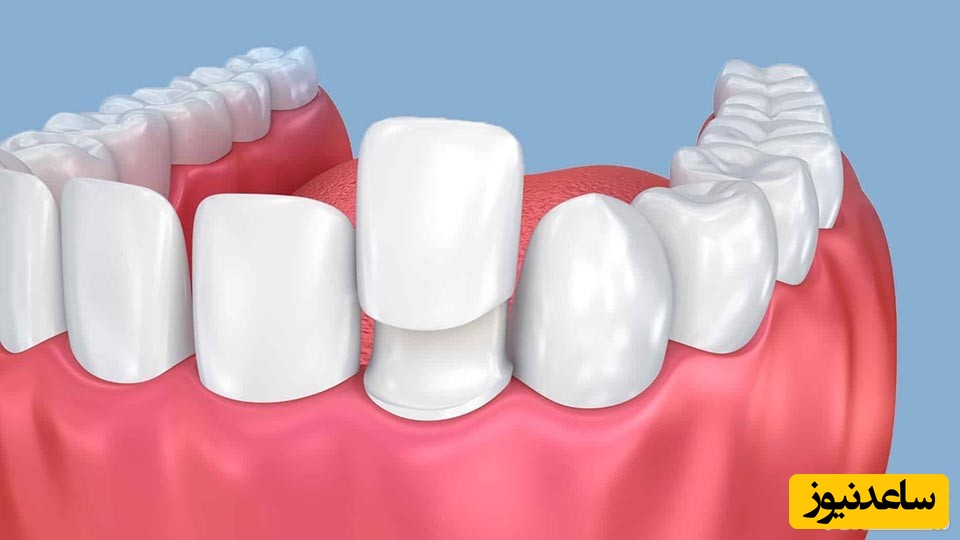 لمینیت بدون تراش دندان چگونه انجام می شود؟