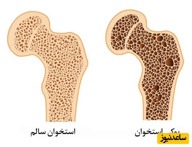 آیا دی هیدروتاچیسترول برای درمان پوکی استخوان مؤثر است؟
