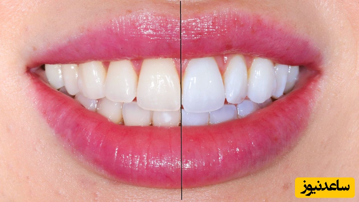 دلیل ایجاد لک روی دندان پس از ارتودنسی