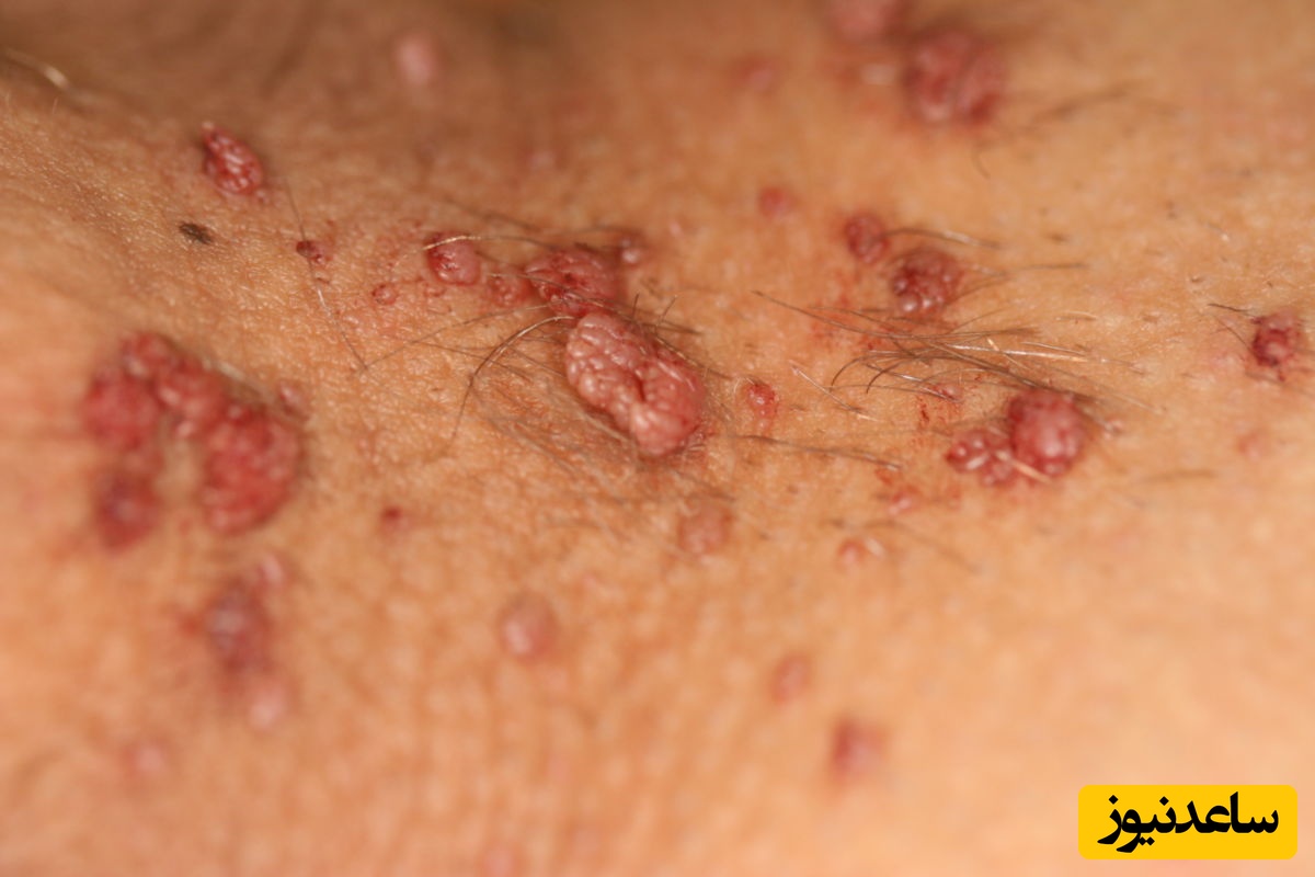 زگیل تناسلی