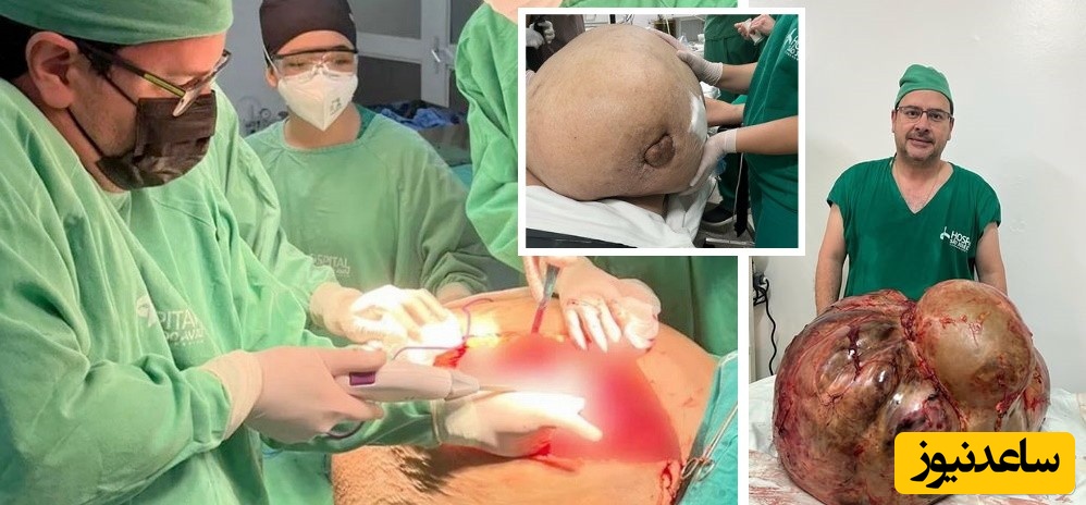 خارج کردن تومور عظیم و باورنکردنی ۴۵ کیلویی از شکم زنی که نمی‌توانست نفس بکشد