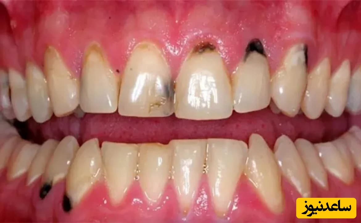 علت سیاه شدن دندان ها و راه درمان آن