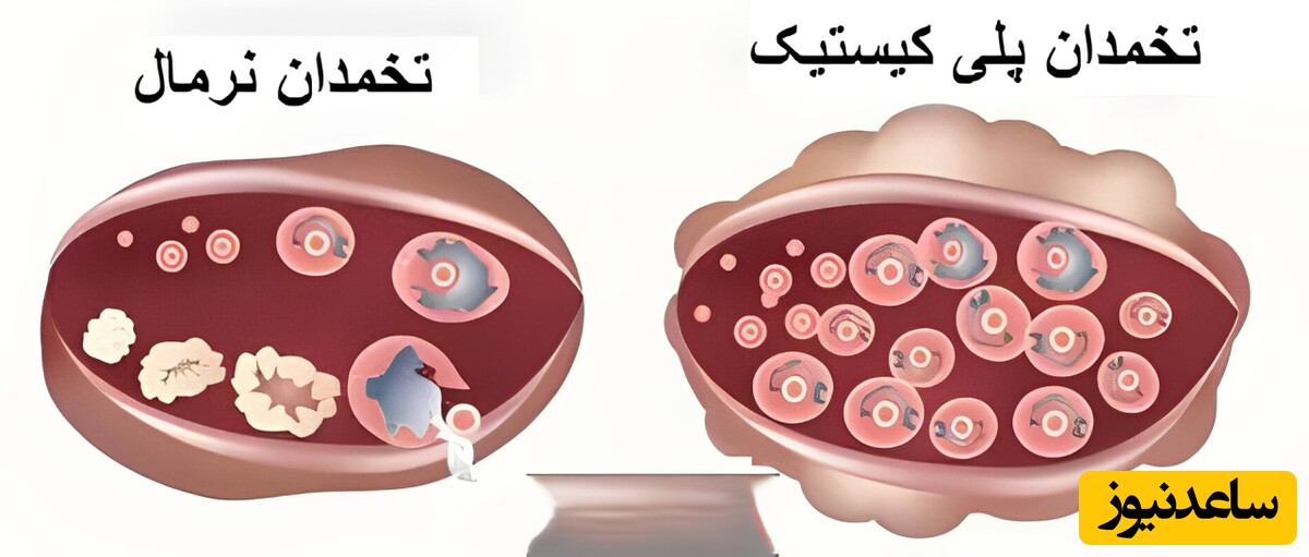 قطع نشدن خونریزی و طولانی شدن پریود چه دلایلی دارد؟