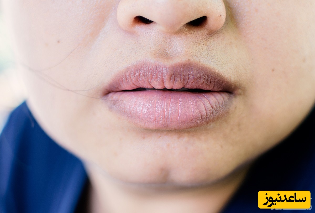 مهم ترین علل تیره شدن لب ها چیست؟