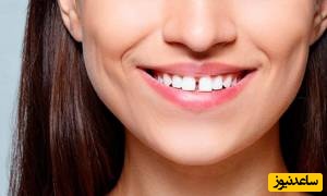 چه عواملی باعث ایجاد شکاف بین دندانها می شود؟