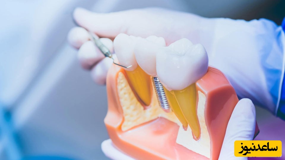 چه کسانی نمی توانند ایمپلنت دندان انجام بدهند؟
