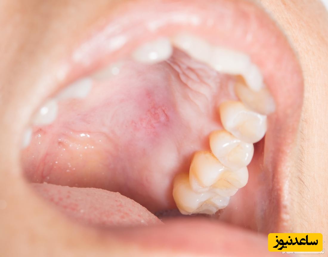 علت خارش سقف دهان چیست؟