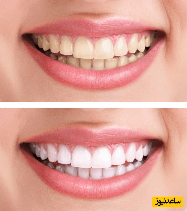 لکه های سفید روی دندان کودک را چگونه درمان کنیم؟