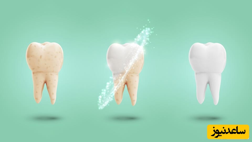 هیپوپلازی مینا چیست؟