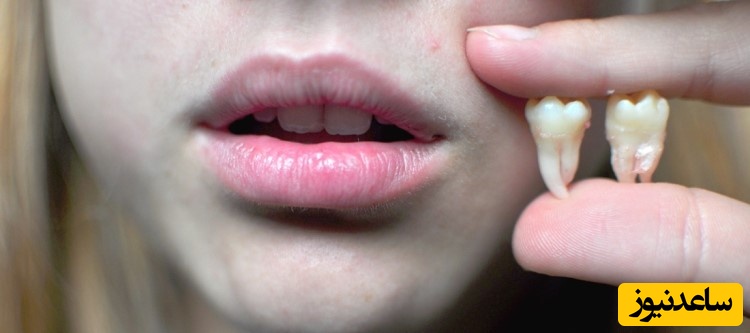 مشکلات بعد از کشیدن دندان عقل چیست؟