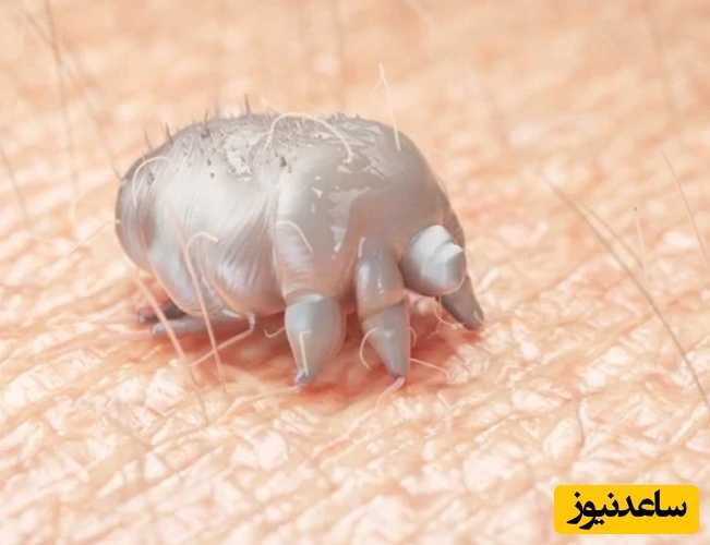 درمان قطعی گال با طب سنتی؛ گیاهان دارویی و روش‌های خانگی موثر