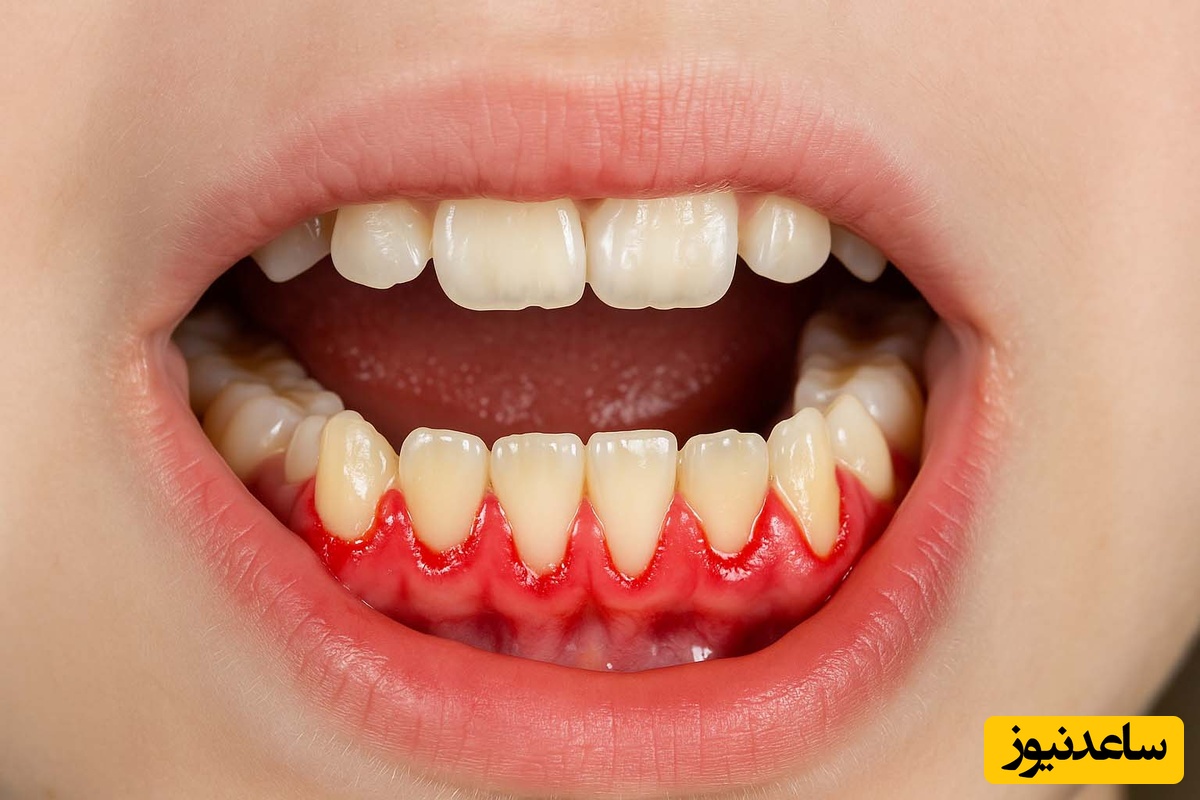 پریودنتیت چیست؟