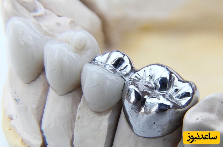 آمالگام چیست؟