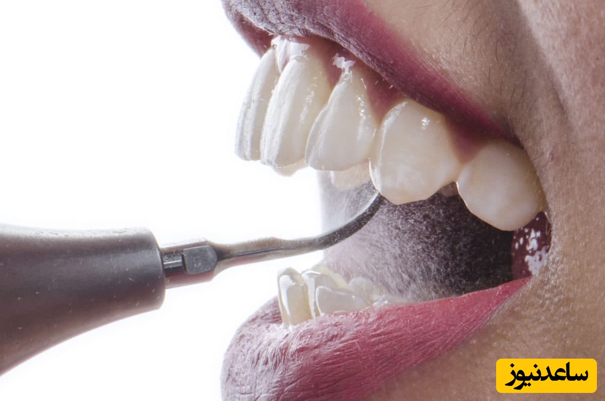 جرمگیری دندان در شیردهی ضرر دارد؟