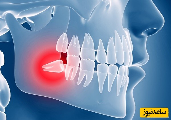 دندان عقل نهفته و عوارض آن